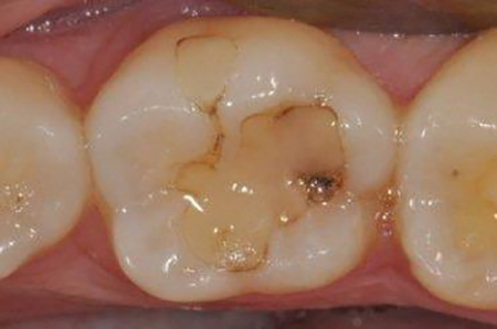 otturazione estetica molare inferiore